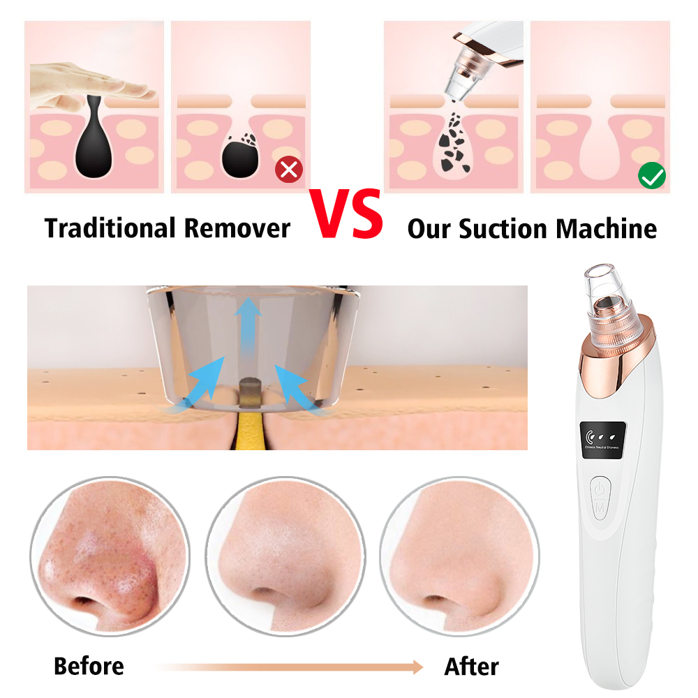 Blackhead Remover Vacuum Pore  - Nasal Aspirator 评论和价格